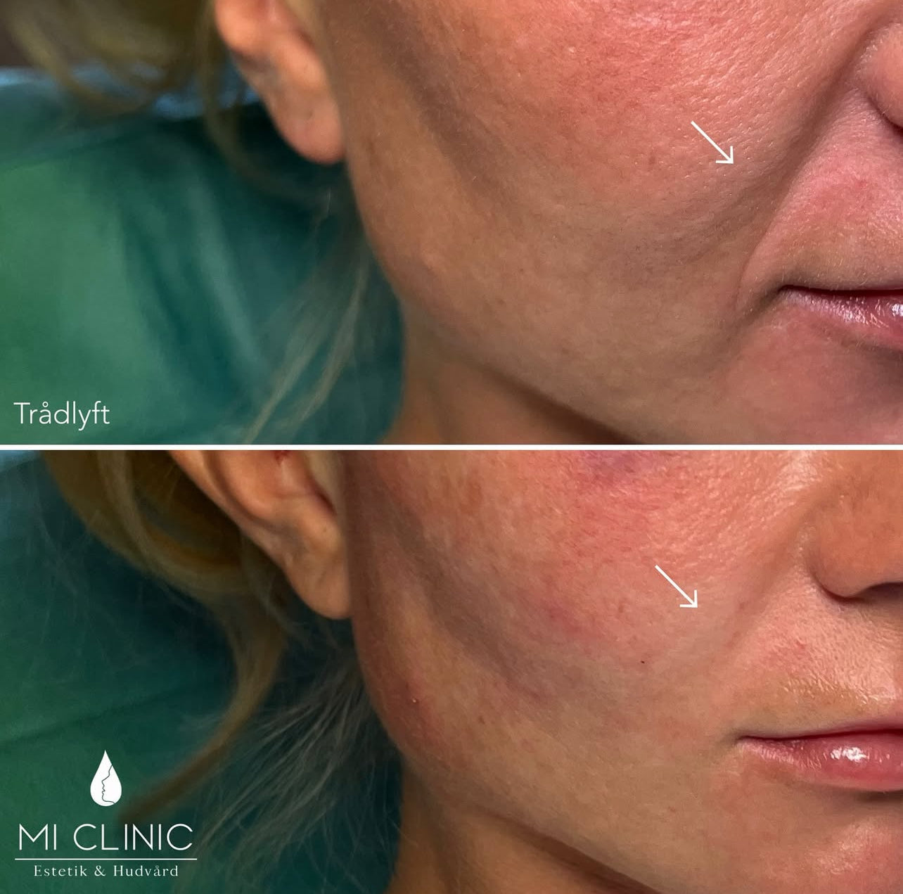 Före- och efterjämförelse av ansiktshud hos kvinna efter estetiska behandlingar med LOOKS sthlm