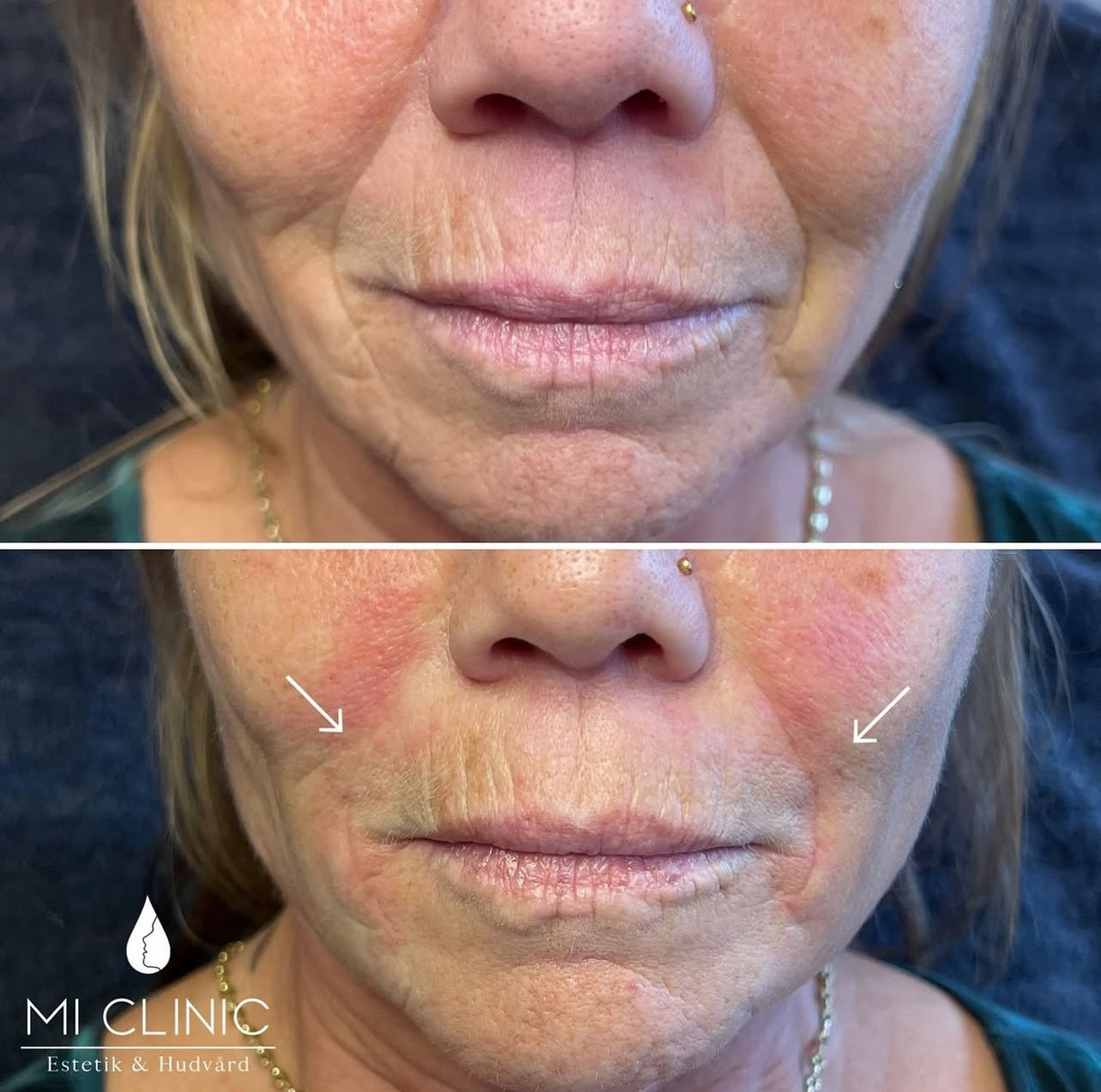 Resultat av estetiska behandlingar på kvinnas ansikte hos LOOKS sthlm