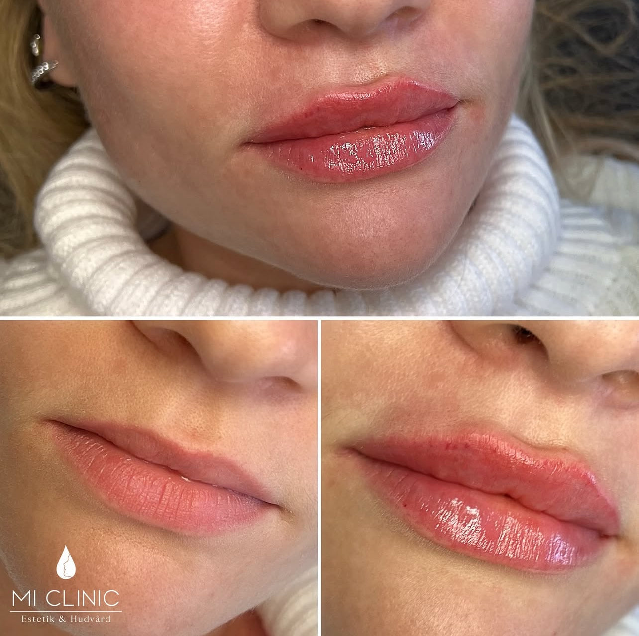 Före- och efterjämförelse av kvinnas läppar efter fillersbehandling hos LOOKS sthlm
